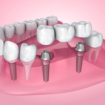 Illustration of dental implants and bridge