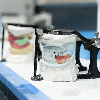 Partial denture manufactured in lab