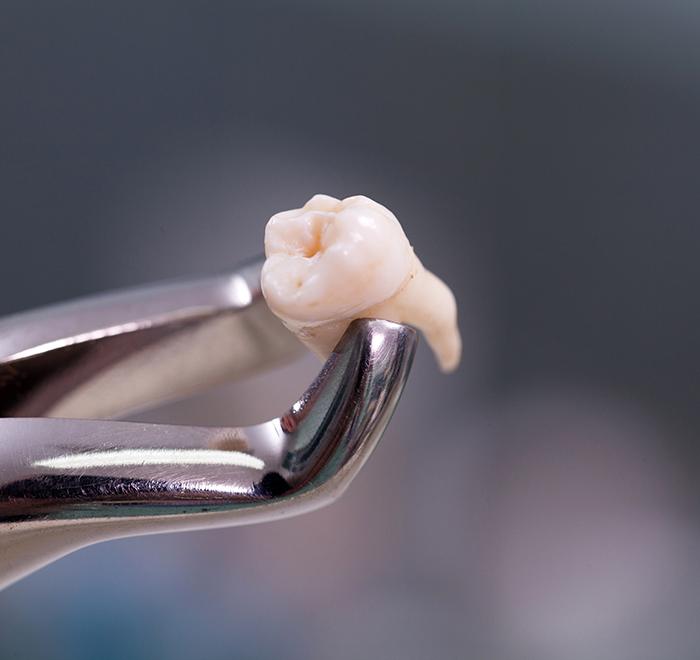 Closeup of forceps holding extracted tooth