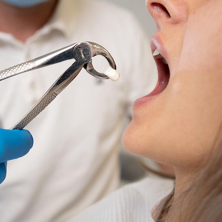 Dentist in blue gloves pulling extracted tooth out of patient’s mouth